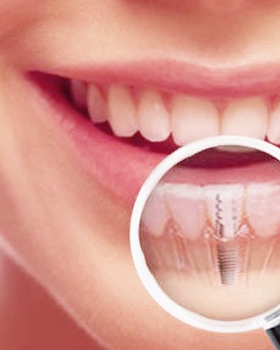Dental Implants